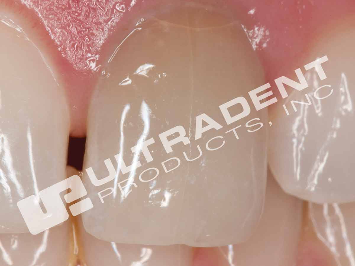 Opalescence Endo
