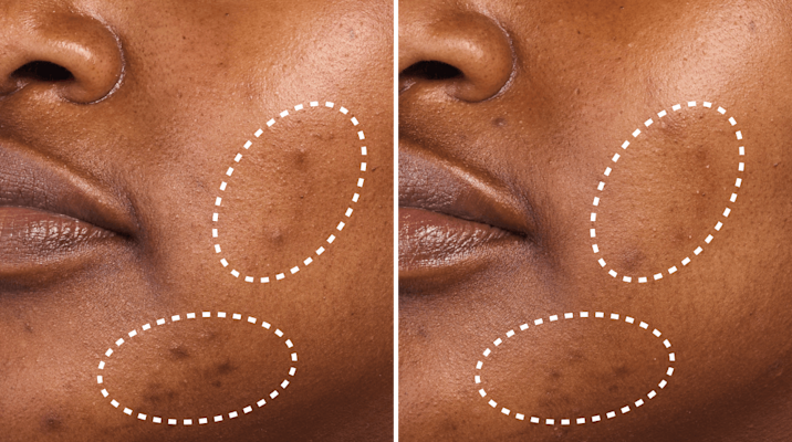 Dark Spot Serum to reduce the appearance of hyperpigmentation