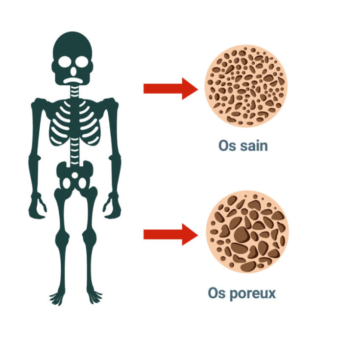definition-osteoporose-personnes-agees