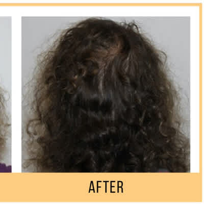 Keravive Hair Growth Treatment 