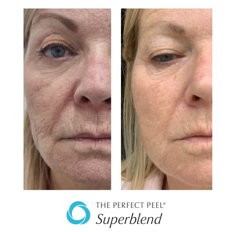 The Perfect Peel Superblend at Elegant Clinic
