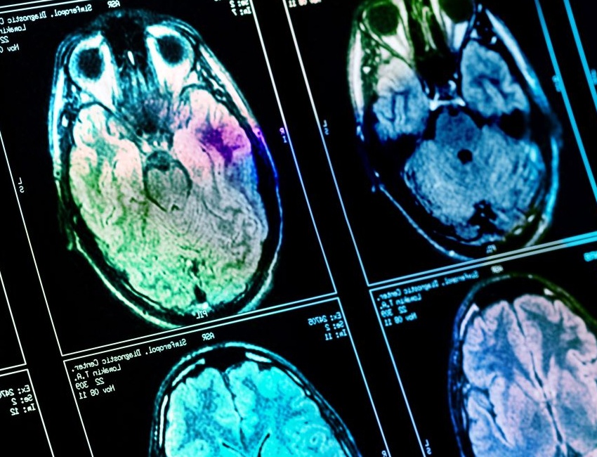 Brains scan to detect Alzheimer’s disease