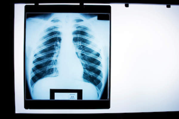 Rib cage x-ray.