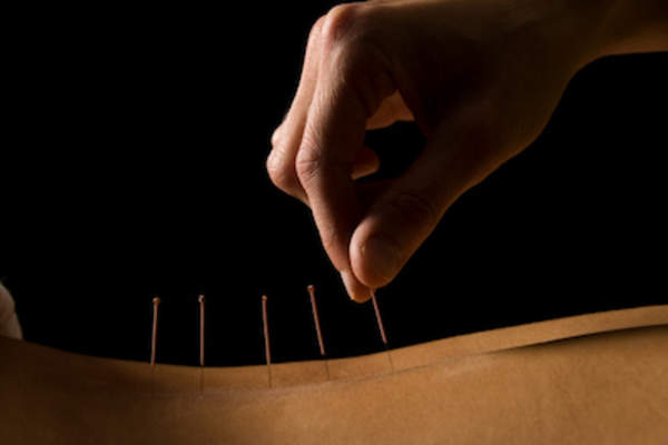 Acupuncture treatment.