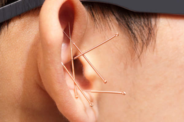 Acupuncture for smoking cessation is usually performed on ear.