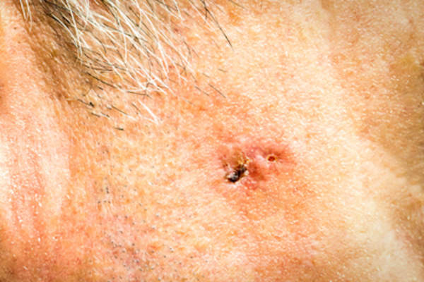 Face melanoma