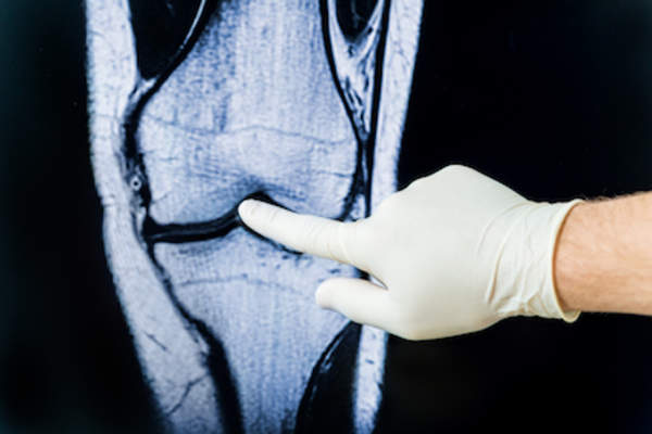 Doctor examining x-ray of knee for signs of osteoarthritis