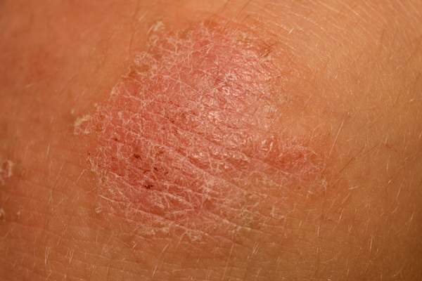 Psoriasis scale on skin.