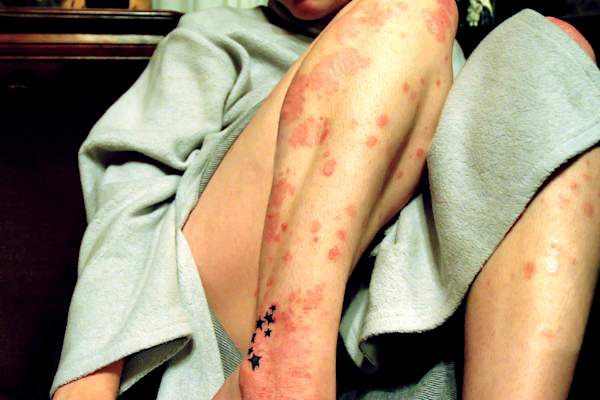 Psoriasis skin flare.
