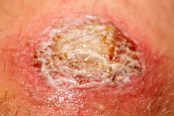 Skin infection.