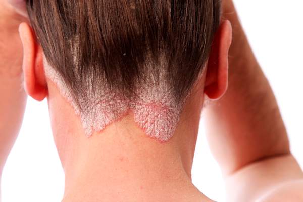 Psoriasis on back of neck.