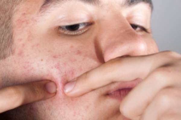Person squeezing pimple
