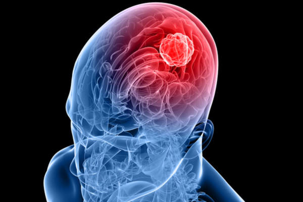 glioblastoma