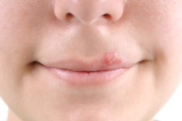 Cold sore image.