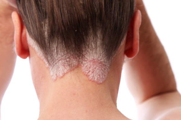 psoriasis