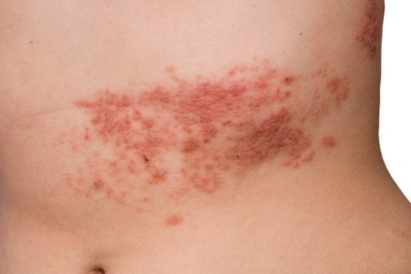 Shingles