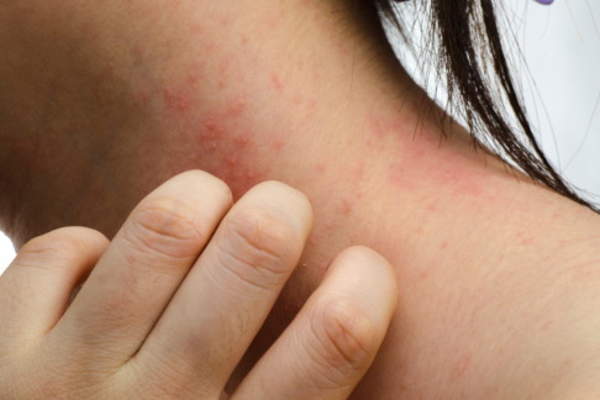 Woman grabbing neck due to skin condition