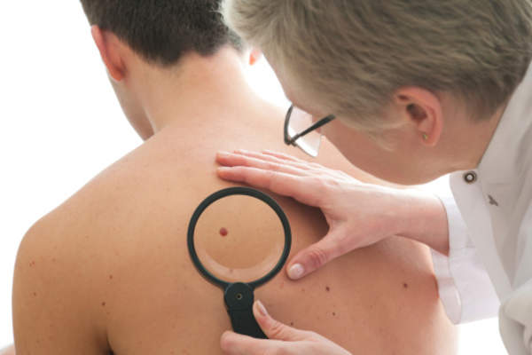 Doctor inspects a mole on a patient.