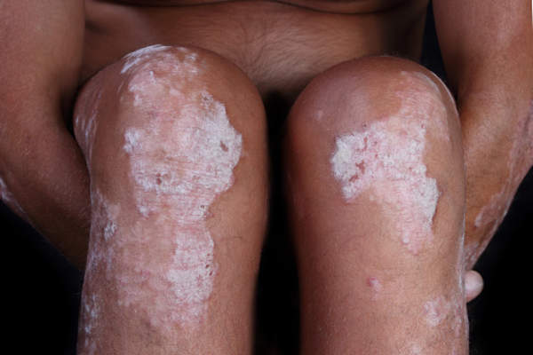 Patient with psoriasis on knees.