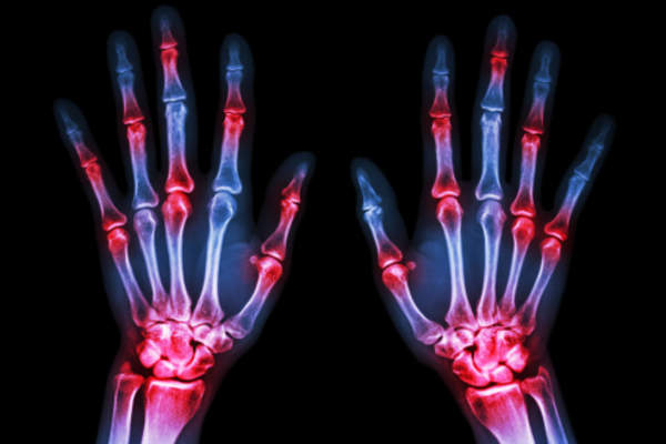 X-ray of hands to examine joints.