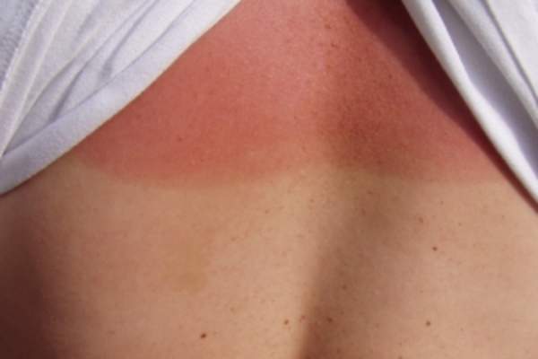 sunburn image