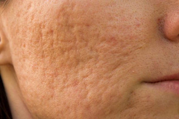 Acne scars