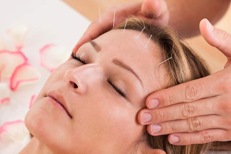 acupuncture for migraine