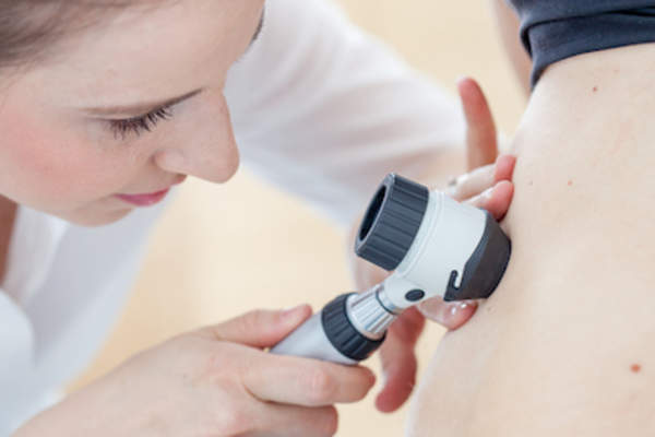Doctor examining a melanoma.