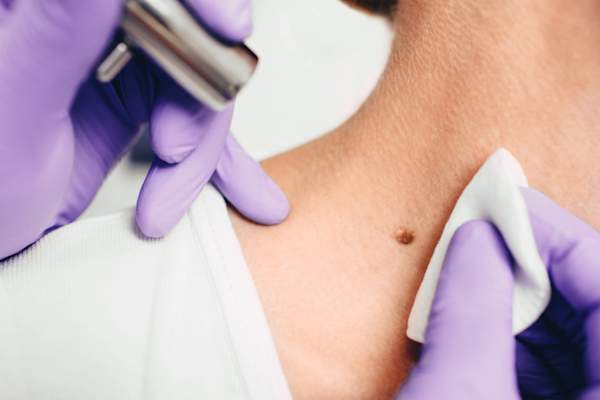 close up on doctor's hand examining mole