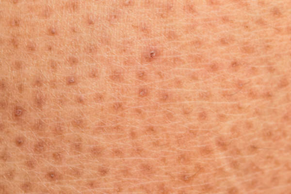 Closeup of skin problem, dry skin ichthyosis vulgaris.