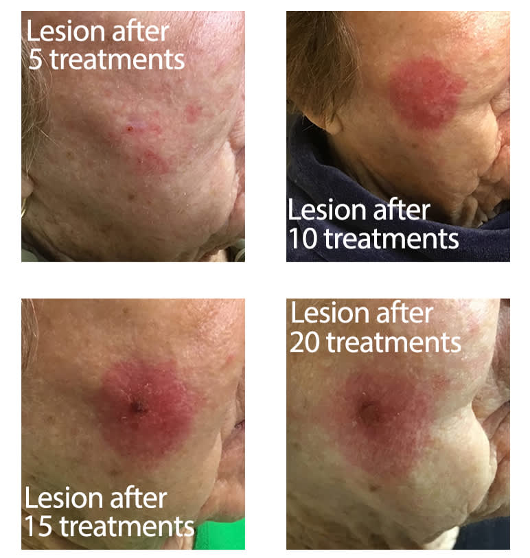 Lesion treatment process