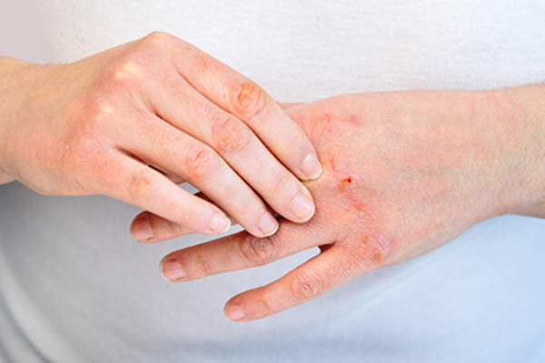 Dry, cracked, bleeding skin on hands.