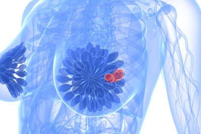 Depiction of breast cancer.