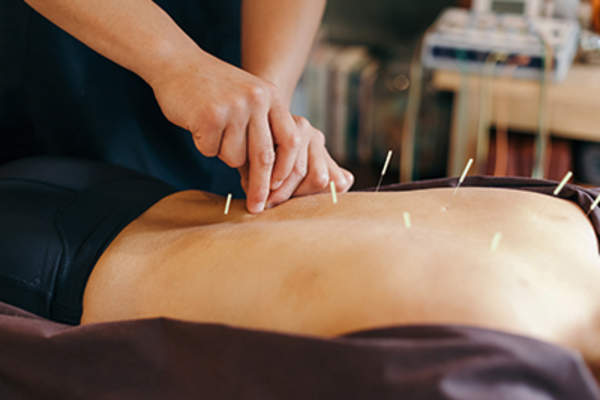 Acupuncture treatment.