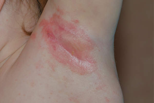 Yeast infection in armpit.