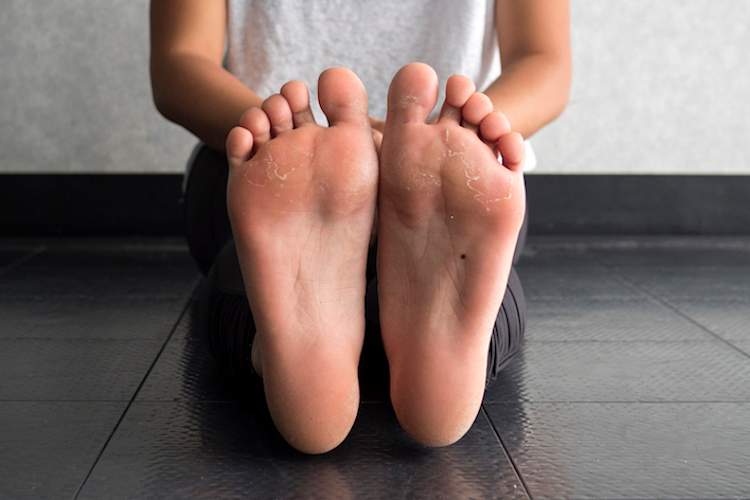Callouses on feet