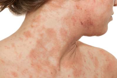 A woman with atopic dermatitis.