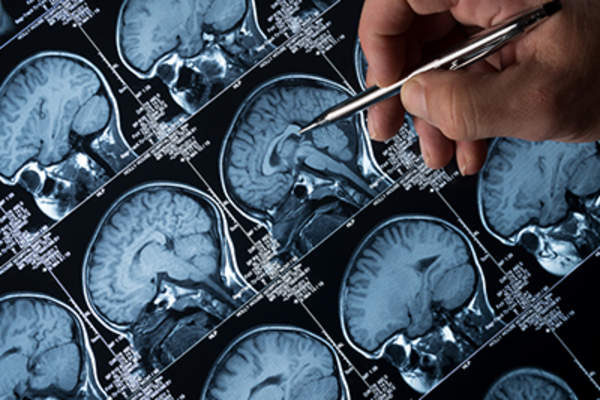 MRI brain scan.