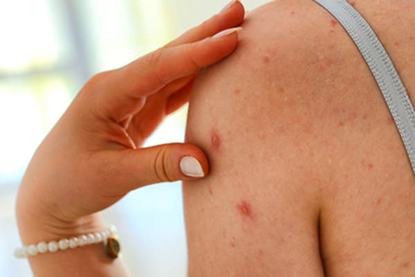 Bacterial skin infection on woman's arm.