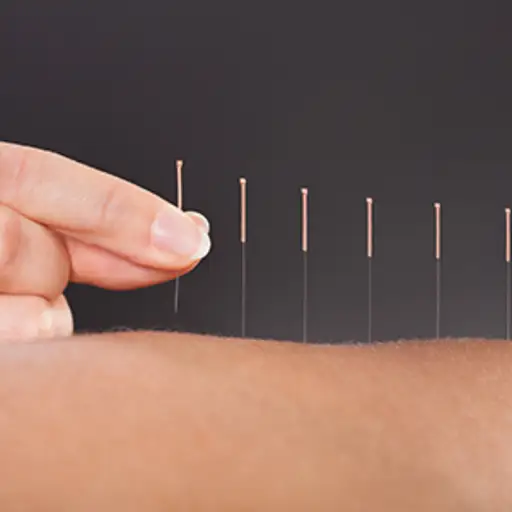 Acupuncture treatment.