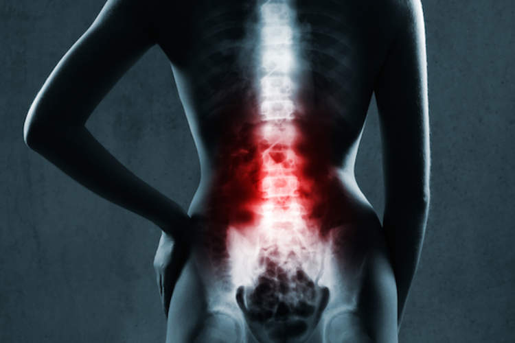 X-ray view of a woman with low back pain.