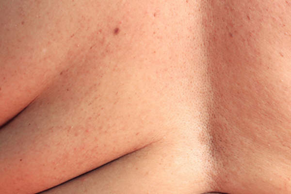Skin on back of overweight person.