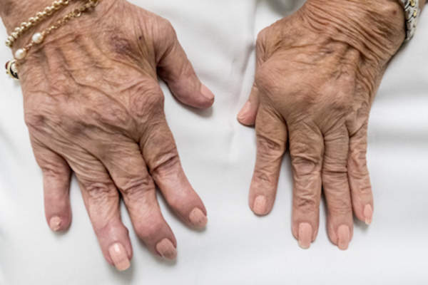 deformed hands from RA