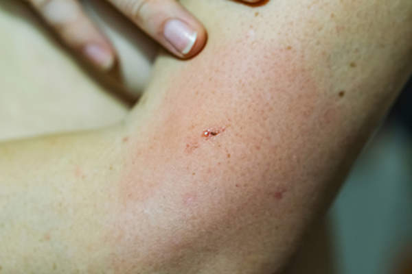 Skin redness on arm.