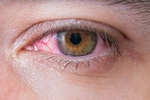 Close up of eye irritation, inflammation, redness.