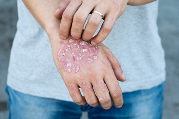 Psoriasis scales on the hand.