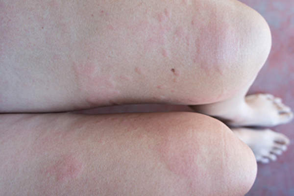 Hives on legs.