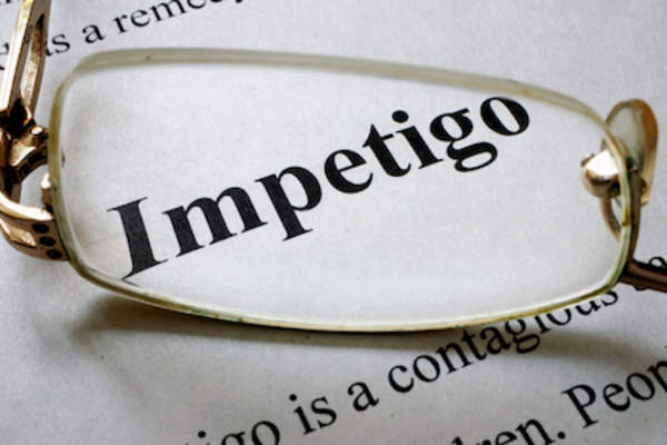 Paper with word Impetigo magnified by glasses.