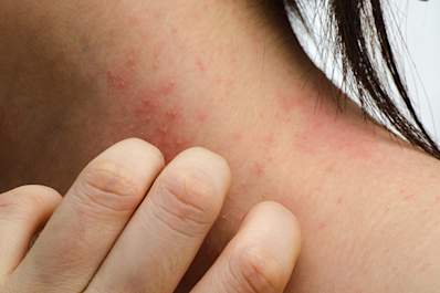 Woman scratching eczema on her neck.