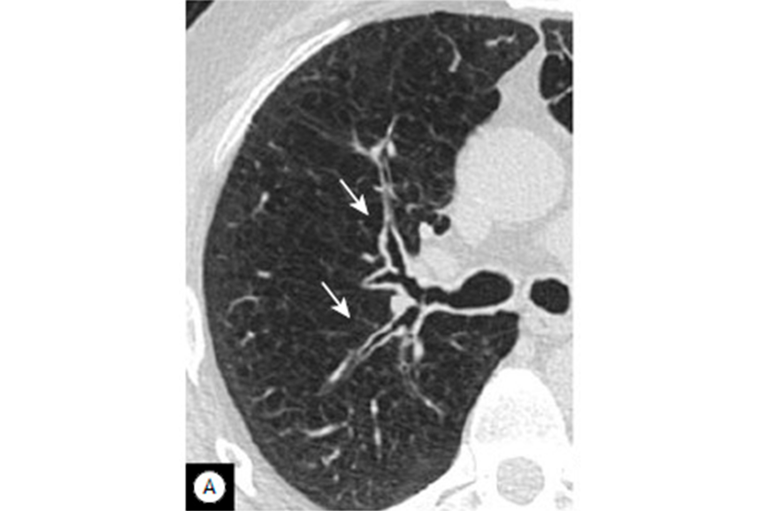 Copd Ct Scan Findings